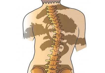 Treating Scoliosis Blog Post Utah Physical Therapy